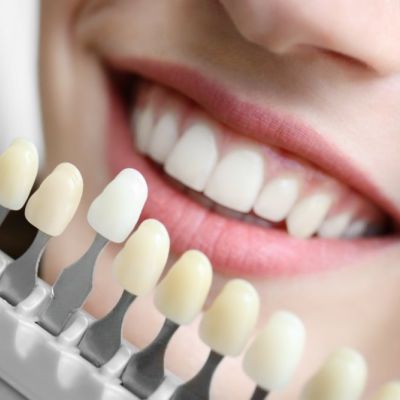 Zahnarzt-Hildesheim-Bleaching-Farbring-empfindliche-Zähne