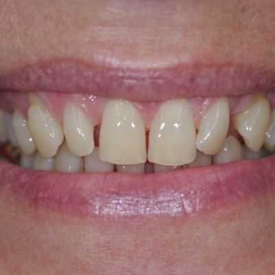 Zahnarzt-Hildesheim-Leistungen-Veneers-Serie-Bild1-vorher