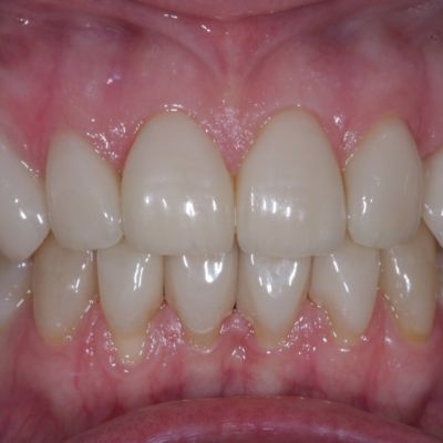 Zahnarzt-Hildesheim-Leistungen-Veneers-Serie-Bild3-nachher-Ansicht-Zahnfleisch
